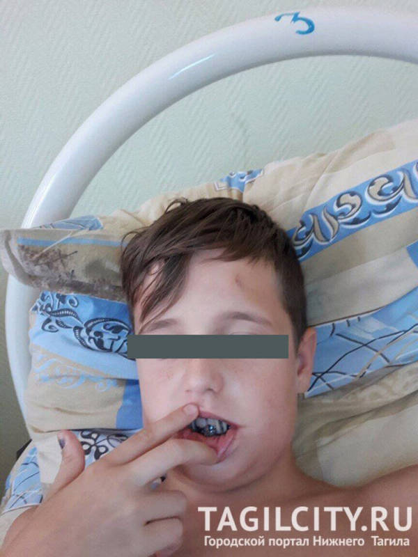 Ребёнок был госпитализирован, ему была сделана операция. Фото: TagilCity.